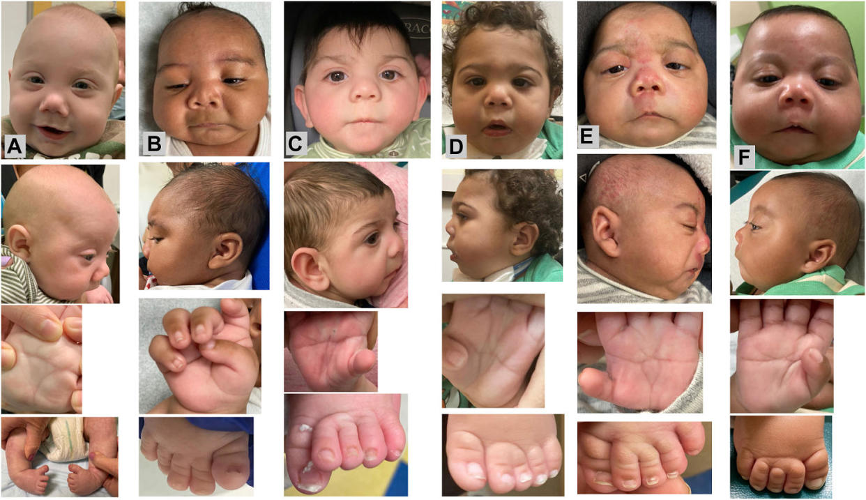 facial photographs of Individuals 1-6 (A-F) as used in the GestaltMatcher analysis. (Elsevier 2023)