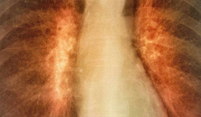 The Biggest Breakthrough Lung Cancer Medicine Can't Get Through the FDA