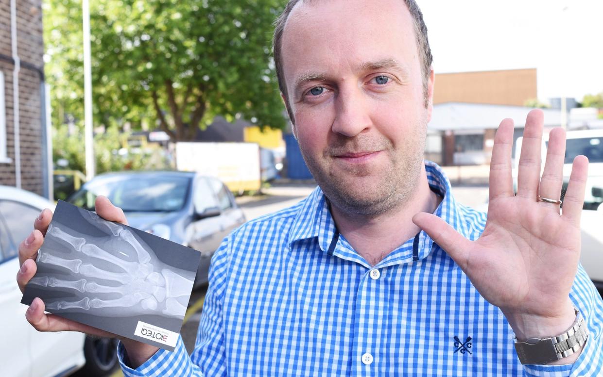 Steven Northam with an x-ray of his hand  - Solent News & Photo Agency