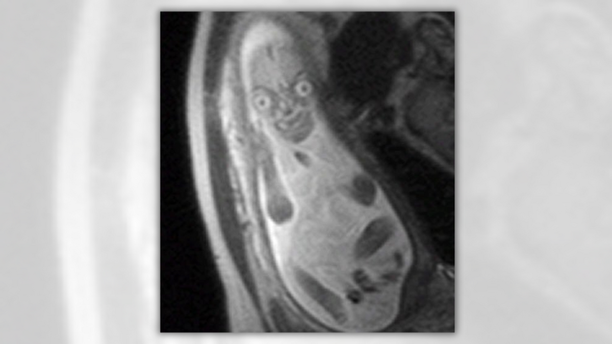 An X-ray shows what looks like a bowling pin with an evil face appearing on it. 