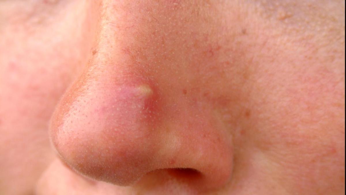 Can Popping Nose Pimples Lead to a Deadly Brain Infection?