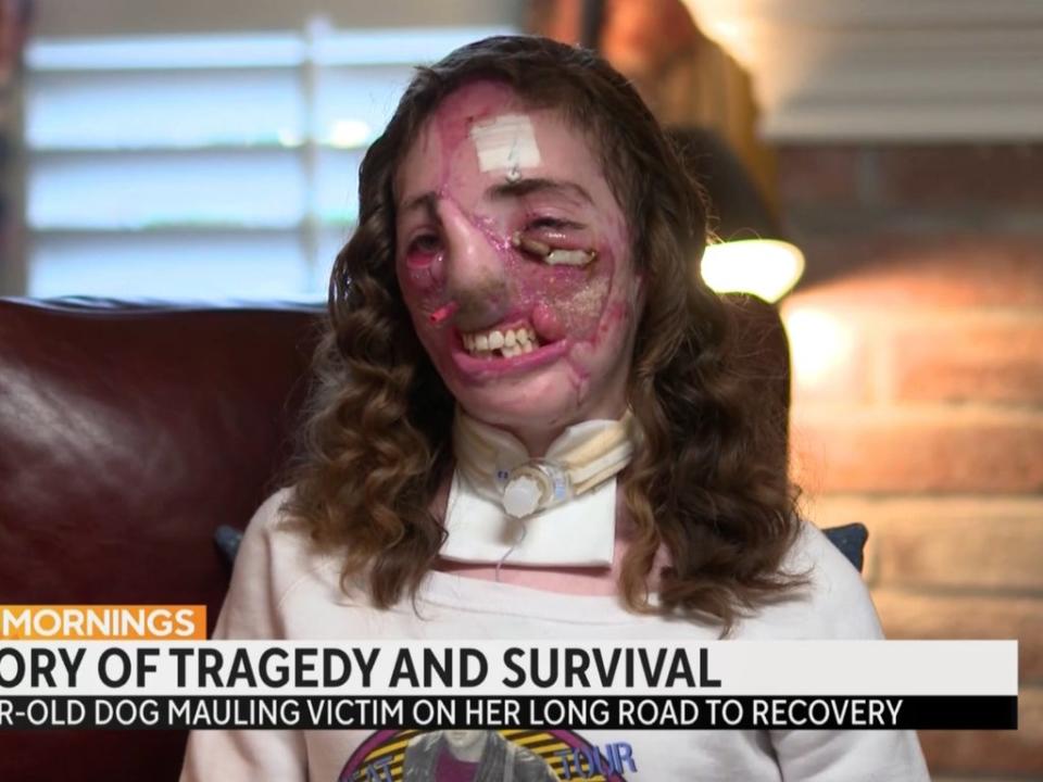 Jacqueline Durand after reconstructive surgery, though still in an early stage of her recovery (CBS News)