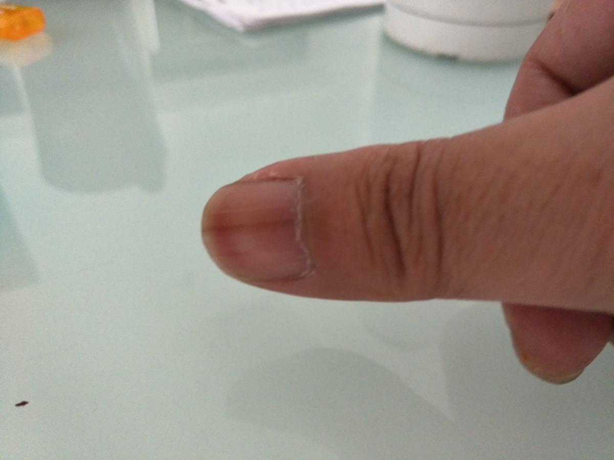 皮膚專家健康網.tw-指甲片突然變黑了－指甲下出血