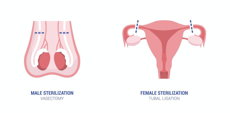 The two common forms of sterilization, or permanent birth control, are vasectomy for men and tubal ligation for women. <a href="https://www.gettyimages.com/detail/illustration/male-and-female-sterilization-royalty-free-illustration/1133181391?phrase=vasectomy%20tubal%20ligation&adppopup=true" rel="nofollow noopener" target="_blank" data-ylk="slk:elenabs/iStock via Getty Images Plus;elm:context_link;itc:0;sec:content-canvas" class="link ">elenabs/iStock via Getty Images Plus</a>