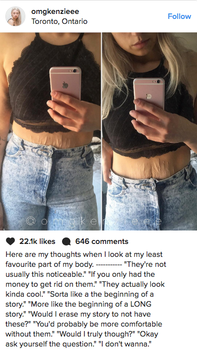 Body-positive blogger and eating disorder survivor Kenzie Brenna @omgkenzieee shares her inner monologue about her least favorite body part.