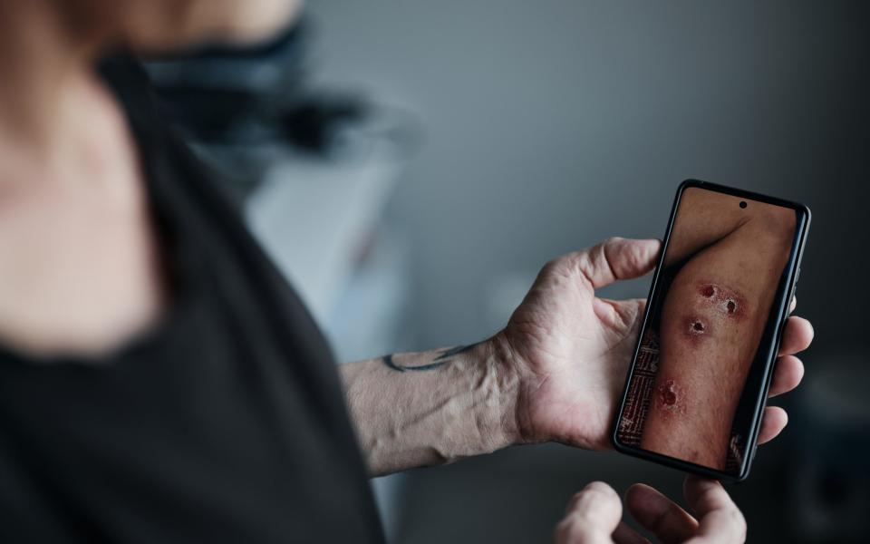 A prisoner of war holds up a photo of cigarette burns on his leg