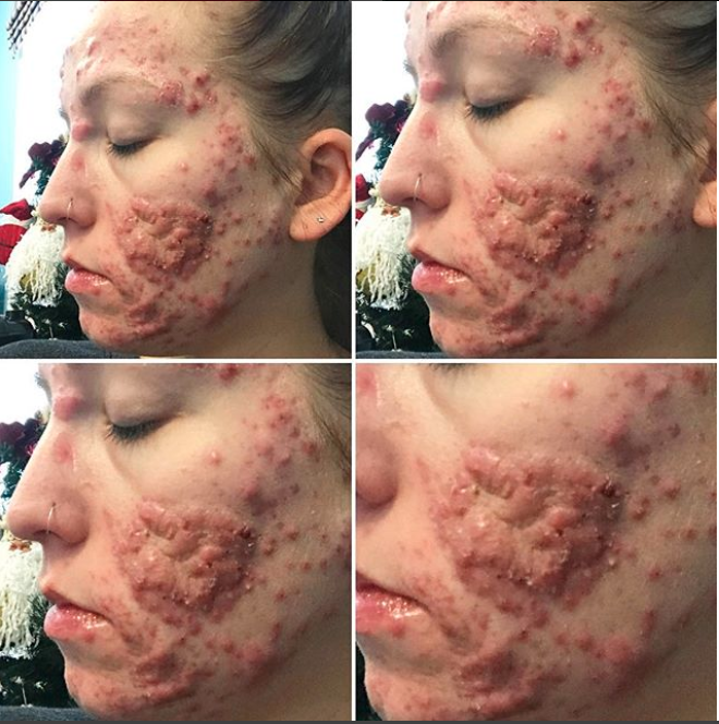 Son acné ne s’arrange pas et lui fait perdre confiance en elle. (Photo : Instagram/stephmkt1d)