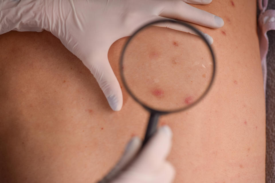 A magnifying glass looking at a mole