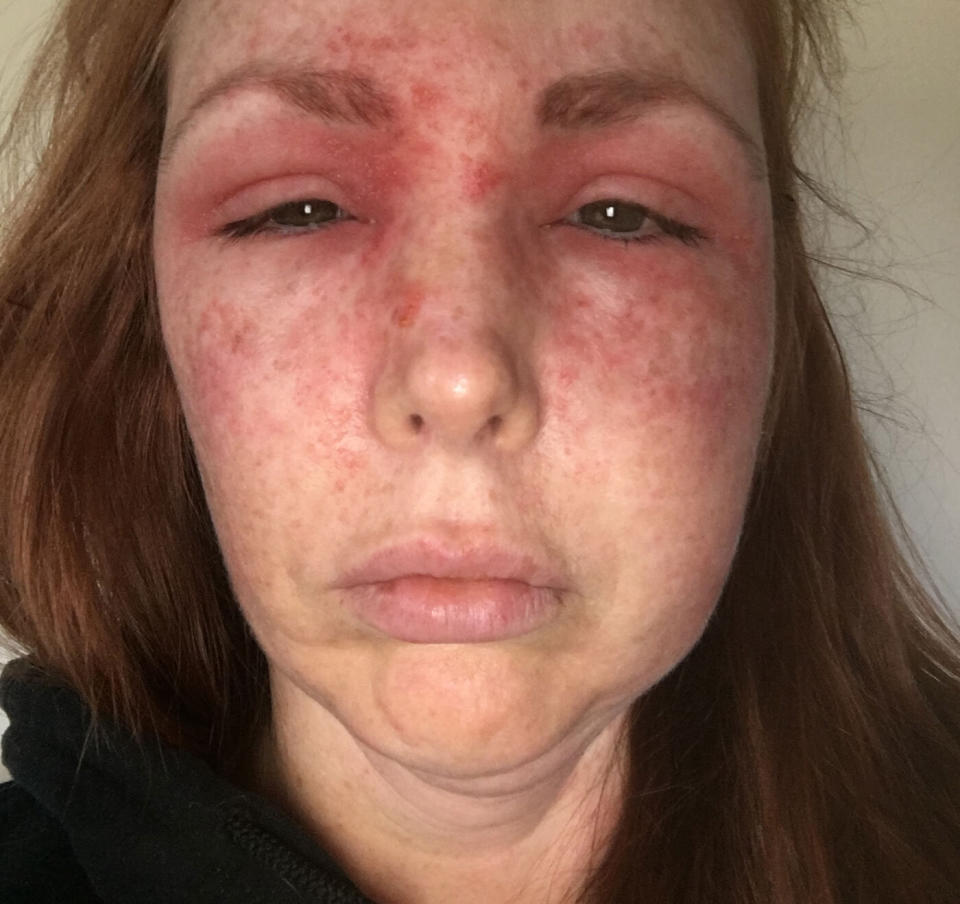 Heidi Plamping's face appears swollen following scratches from her cat.