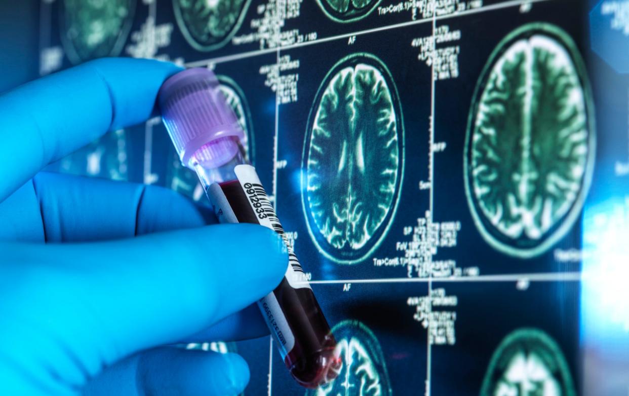 A scientist holds a vial of blood in front of an MRI brain scan image