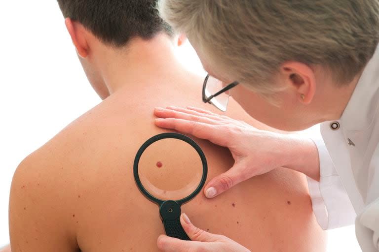 La encuesta realizada por la Sociedad Argentina de Dermatología el año pasado expone que existe un repunte del cáncer de piel en personas por debajo de los 50 años