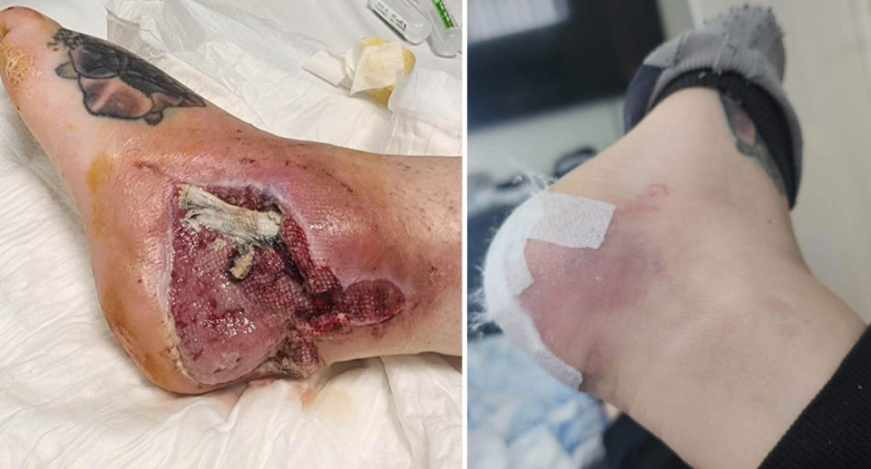 Two pictures of Kristal's foot can be seen with deep swelling and necrosis. 