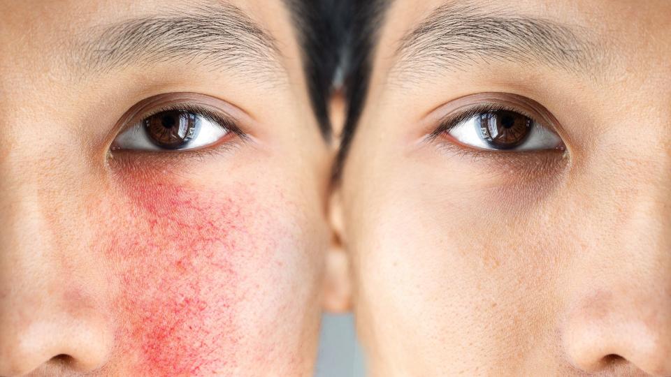 rosacea before and after