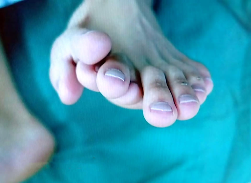 Ajun's extra toes are seen stacked on top of or near his big toe. Source: Australscope.