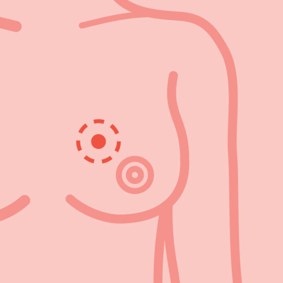 breast cancer lump picture (TODAY Illustrations)