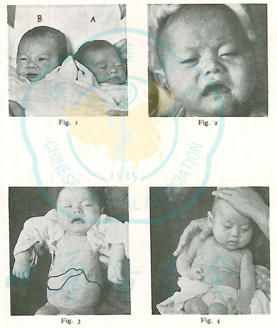 Imágenes de varios pacientes pediátricos de beriberi en Sanghai en una publicación médica de 1936. <a href="https://mednexus.org/doi/epdf/10.5555/cmj.0366-6999.50.04.p324.01" rel="nofollow noopener" target="_blank" data-ylk="slk:Chinese Medical Journals, 1936;elm:context_link;itc:0;sec:content-canvas" class="link ">Chinese Medical Journals, 1936</a>