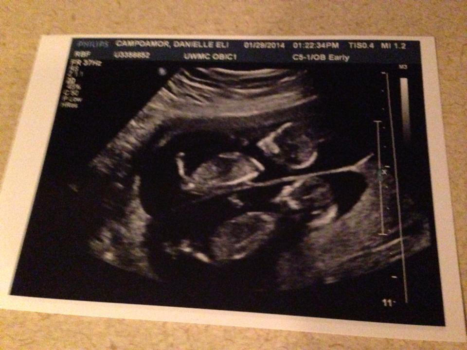 The last ultrasound picture of Twin A and Twin B. (Courtesy Danielle Campoamor)