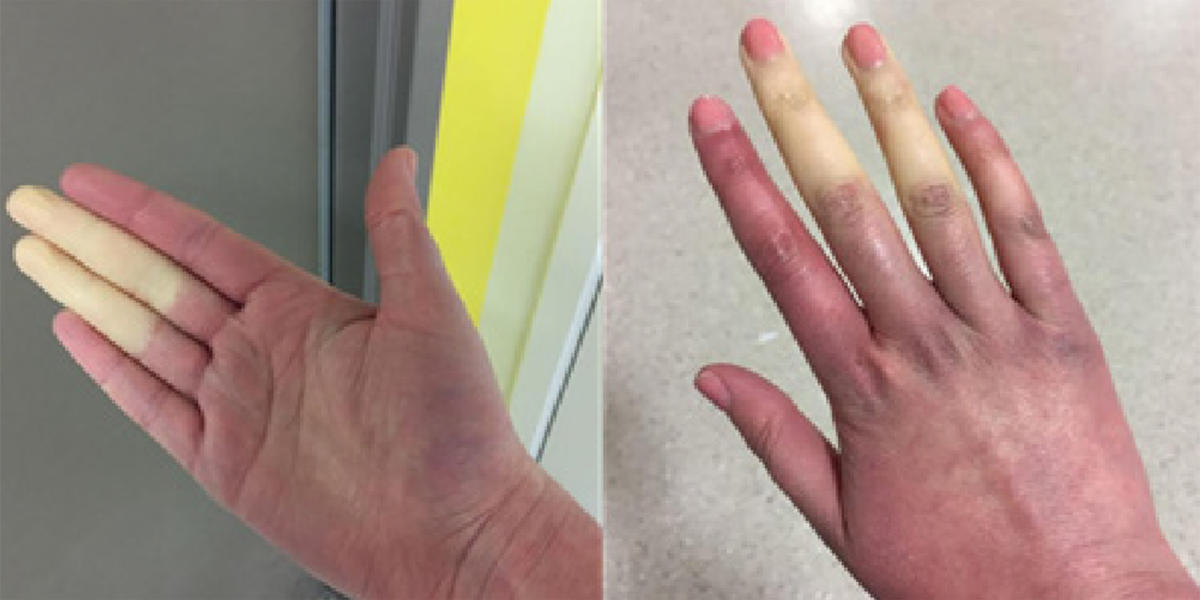 Rare disorder can turn fingers and toes white or blue when it’s cold