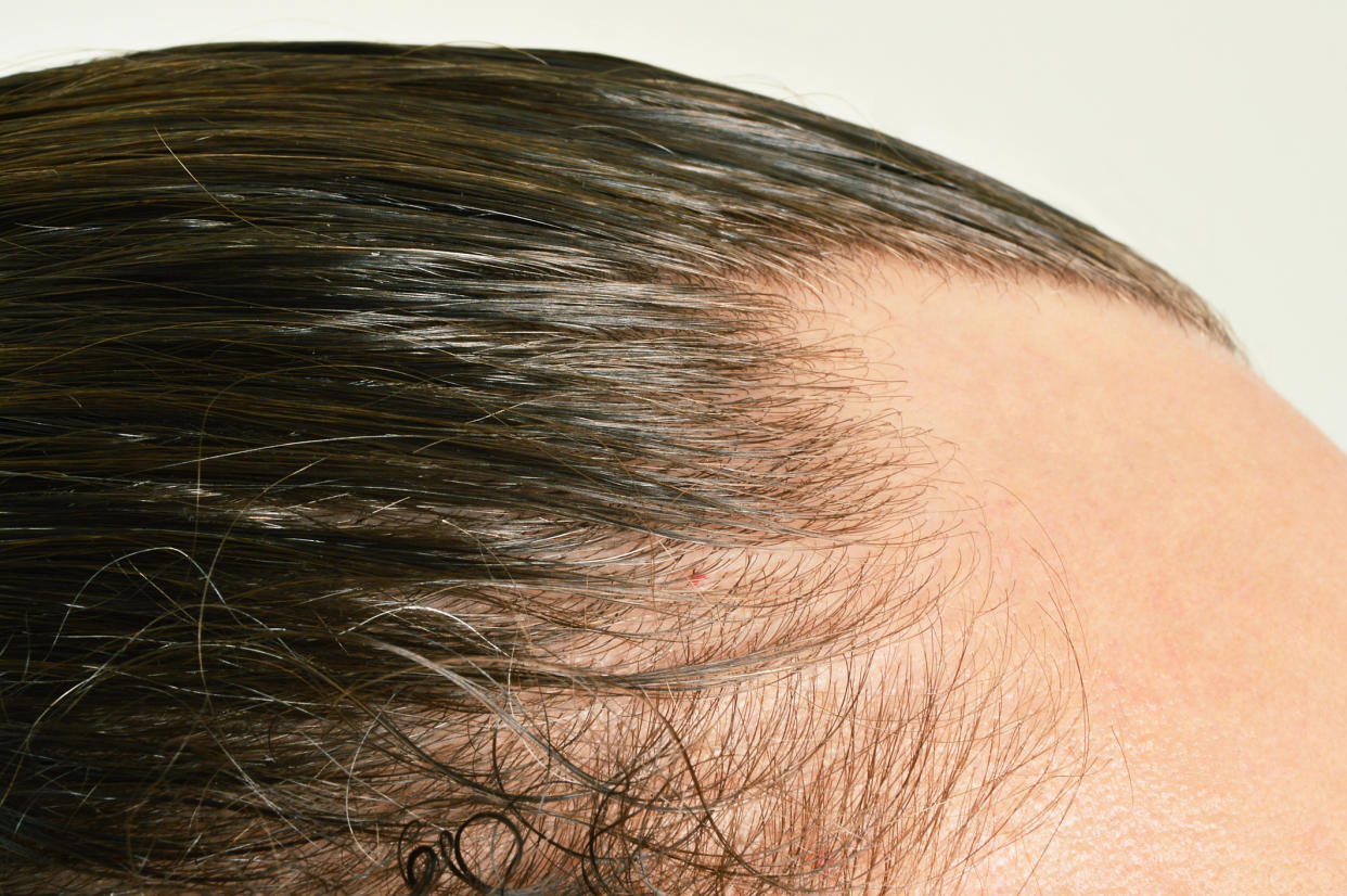 Stock picture of a man's hairline. Stars have been opening up about undergoing a hair transplant. (Getty Images)