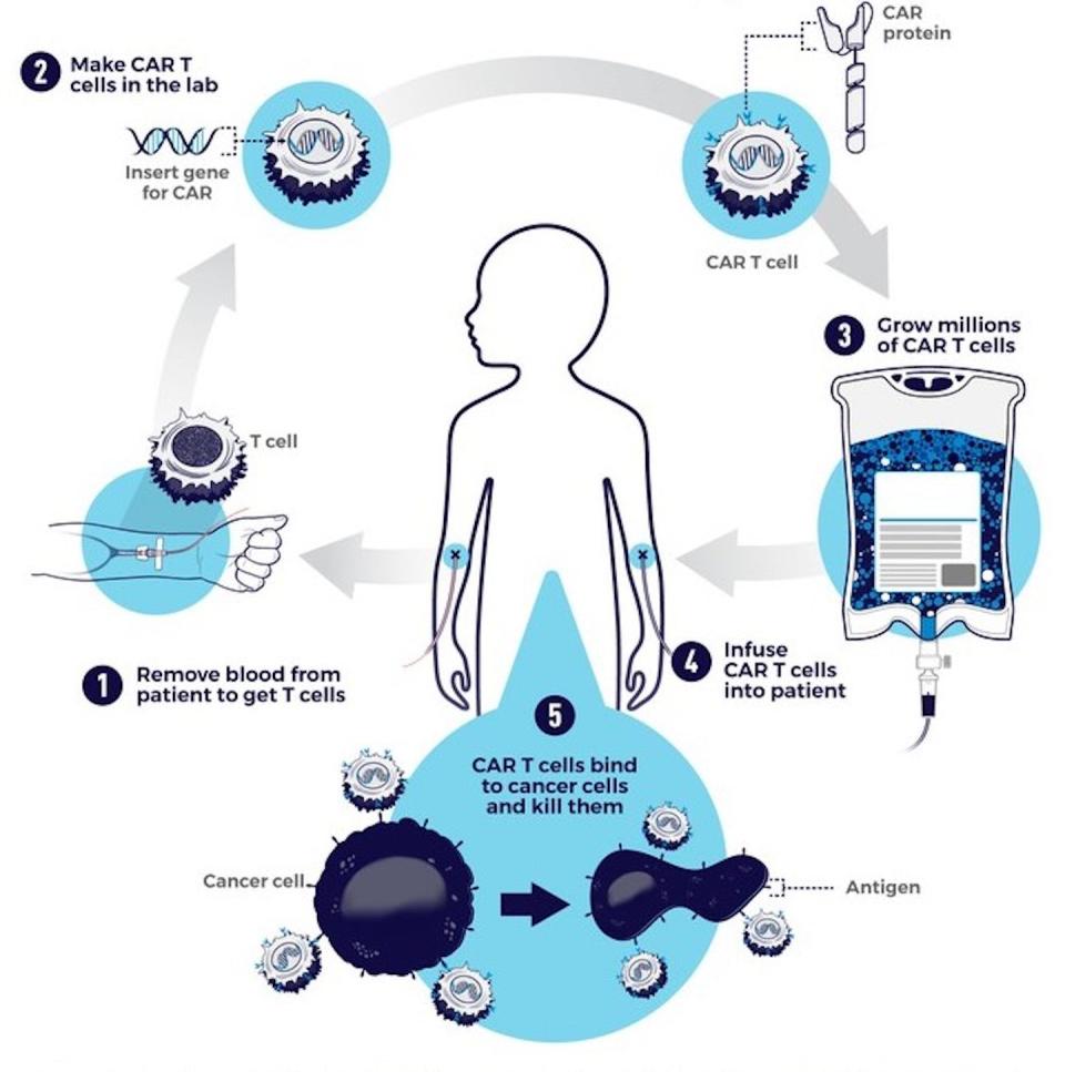 CAR-T therapy involves engineering a patient’s own T cells to attack their cancer. <a href="https://visualsonline.cancer.gov/details.cfm?imageid=12069" rel="nofollow noopener" target="_blank" data-ylk="slk:National Cancer Institute (NCI);elm:context_link;itc:0;sec:content-canvas" class="link ">National Cancer Institute (NCI)</a>