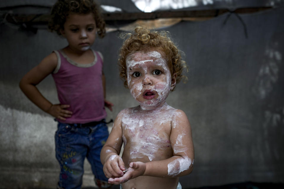 En primer plano, Sham al-Hessi, un niño palestino que padece una enfermedad de la piel, posa para una fotografía en un campamento para desplazados por la guerra en Deir al-Balah, Franja de Gaza, el lunes 29 de julio de 2024. (Foto AP/Abdel Kareem Hana)