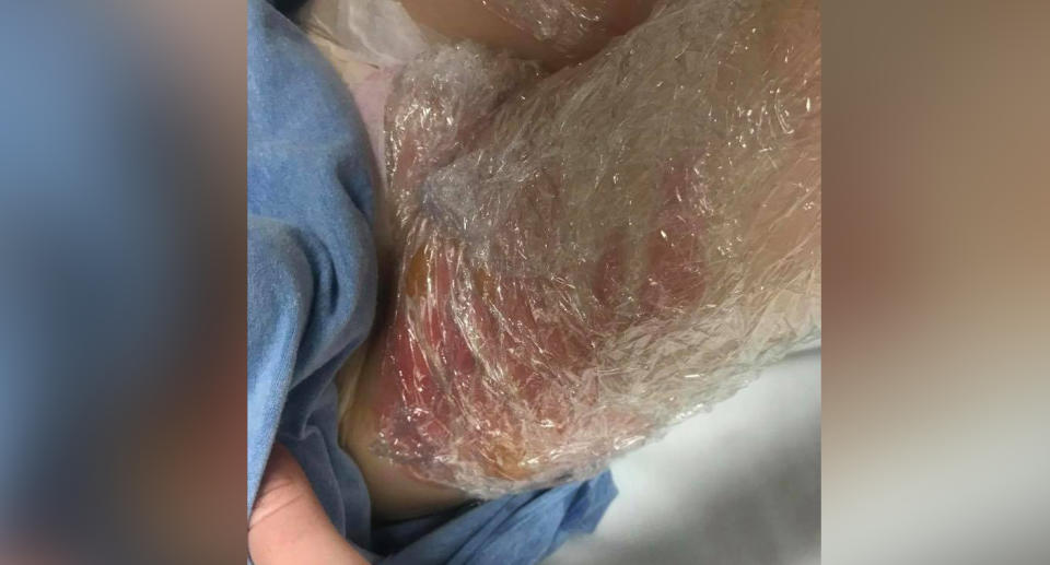 The boy’s burns were covered in glad wrap at the local hospital. Source: Harmony Arrowsmith