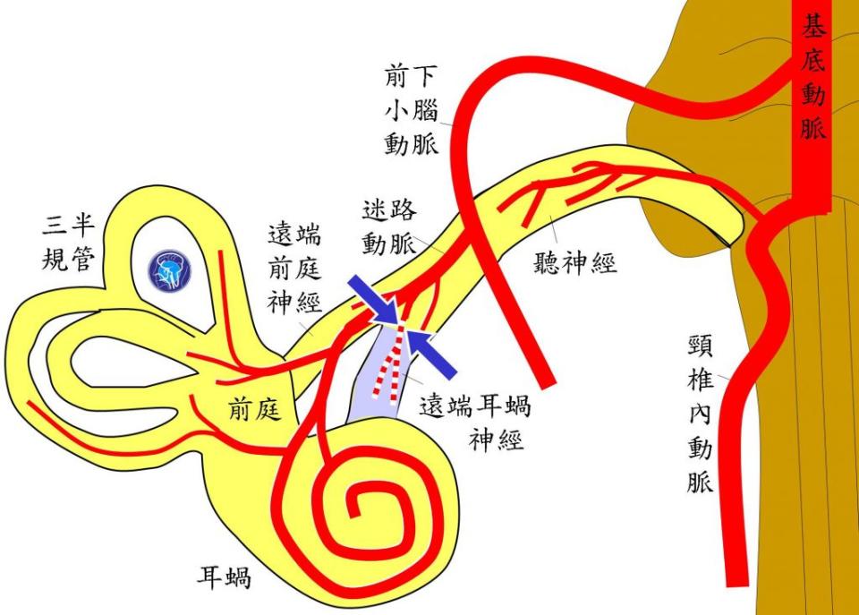 遠端耳蝸神經動脈阻塞（藍色箭頭夾指處），會引起遠端耳蝸神經缺血（淺藍色區域）。（醫師陳建志提供）
