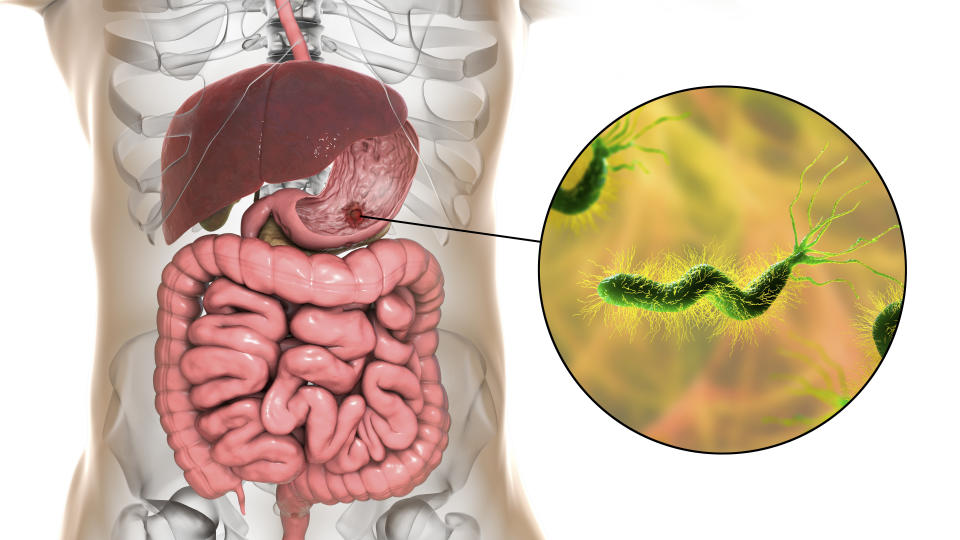 幽門螺旋桿菌（Helicobacter pylori）是一種具有纖毛的螺旋狀細菌，顧名思義，幽門桿菌主要寄生於胃的幽門（胃與十二指腸連接處），主要存在胃裡，有時在腸道、糞便，或是口腔裡的牙菌斑裡也可能發現。（圖片來源：Getty Images）