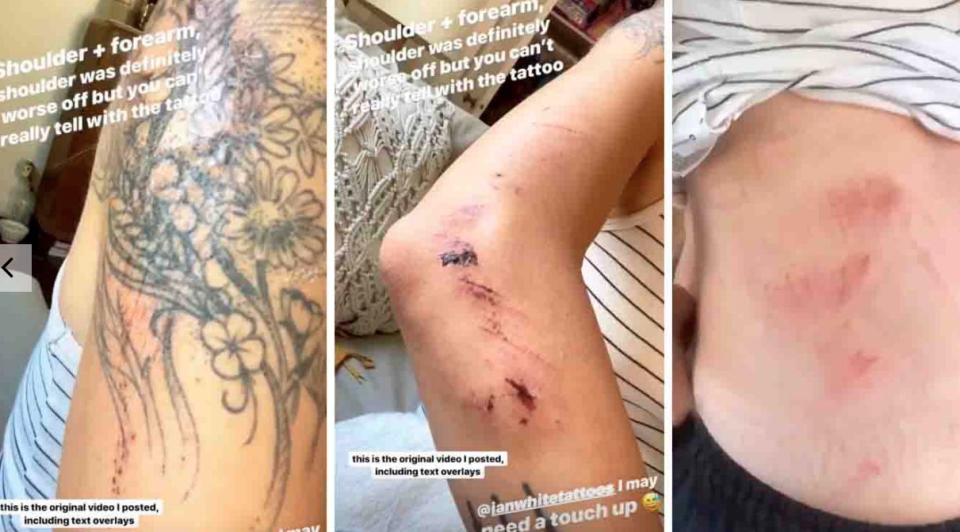 La blogger de estilo de vida Tiffany Mitchell compartió fotos de sus heridas por el accidente de moto. Fuente: Tiffany Mitchell / Instagram. 