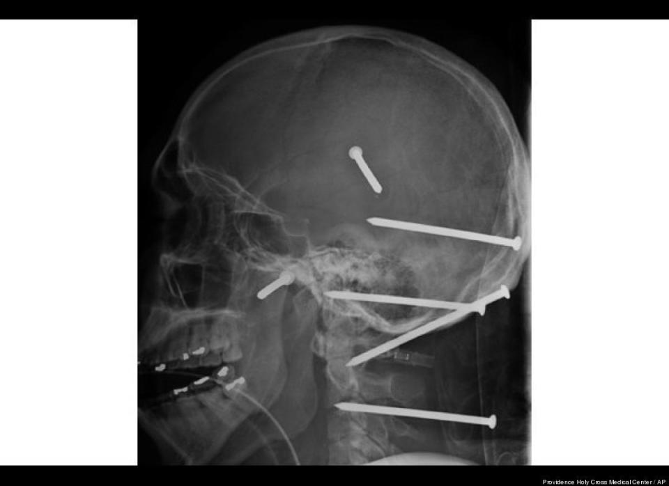 A nail gun shot six nails into construction worker Isidro Mejia's head during an April 2004 accident. He survived and was expected at the time to recover fully.