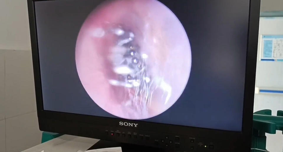 Endoscope vision of spider in woman's ear