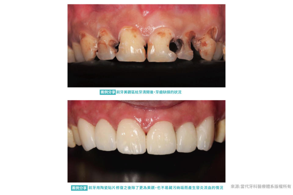 【有影】嚴重齲齒、牙周病不一定要拔牙 顯微根管治療免除重建命運 273