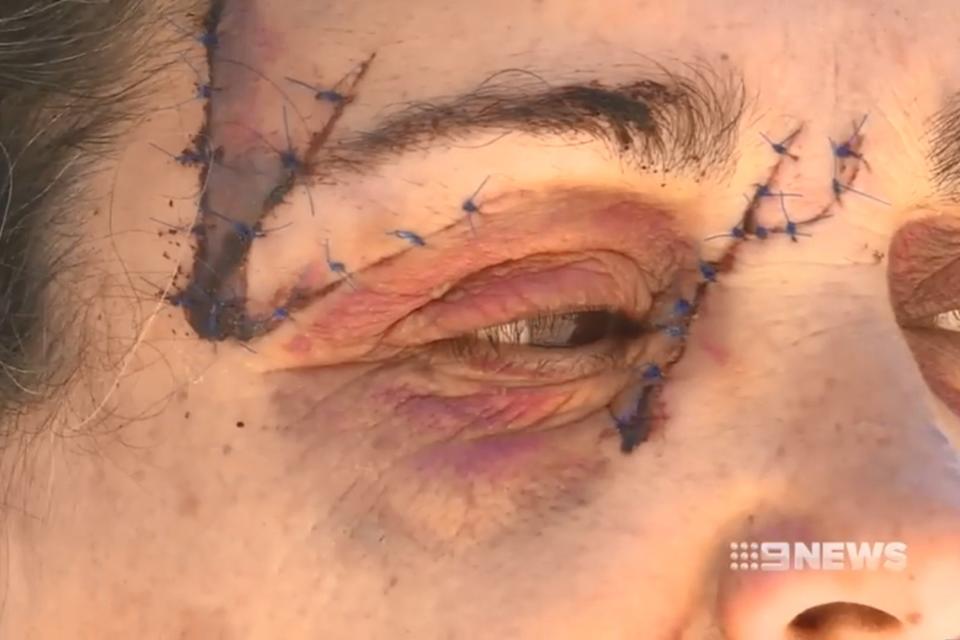 The woman, known as Dina, required 25 stitches to her face (9News)