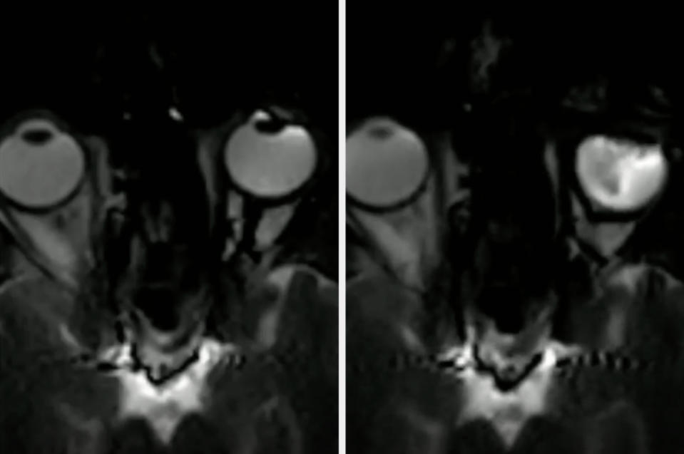 A side-by-side comparison of two MRI scans showing different details of a person's head