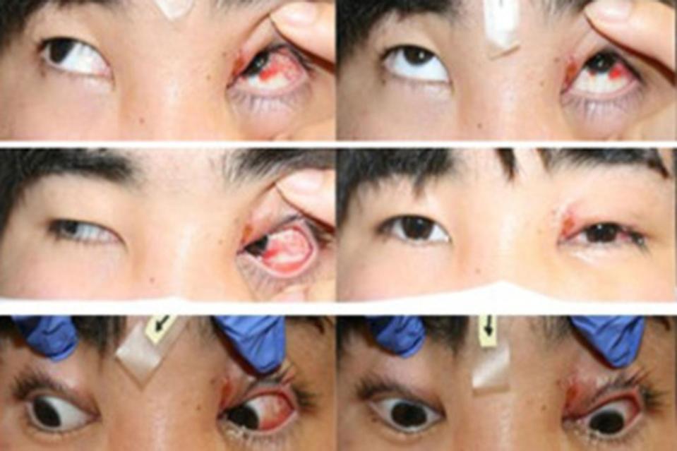 The man now has misaligned eyes after being bitten by a dog. American Journal of Case Reports