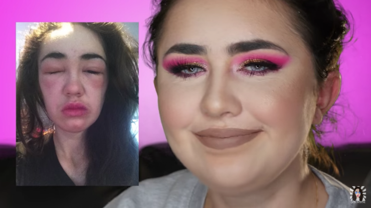 Caito Potatoe shows her allergic reaction to makeup remover.