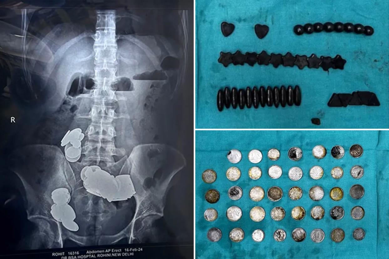 Doctors at a New Delhi hospital removed 39 coins and 37 magnets from a man's intestine after he swallowed the metals under the assumption that ''zinc helps in bodybuilding,