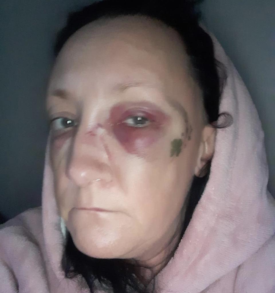 Shelley suffered a broken nose and fractured eye socket following the attack. (Reach)