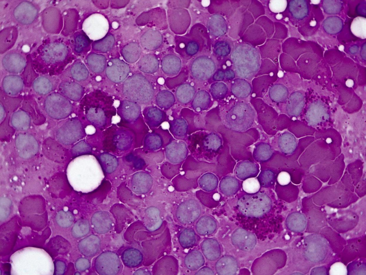 <span>Stem cell transplants involve completely eliminating and then replacing the immune system of a patient, often by transplanting the bone marrow.</span> <span><a href="https://www.gettyimages.com/detail/photo/red-bone-marrow-100x-light-micrograph-royalty-free-image/1168856200" rel="nofollow noopener" target="_blank" data-ylk="slk:xia yuan/Moment via Getty Images;elm:context_link;itc:0;sec:content-canvas" class="link ">xia yuan/Moment via Getty Images</a></span>