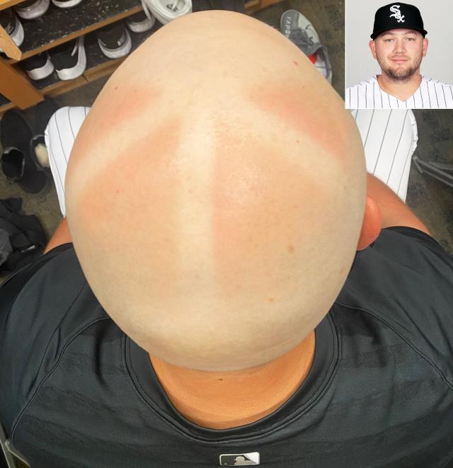 Chicago White Sox 3B Gets Nasty Sunburn on Head, Criticizes New Hats