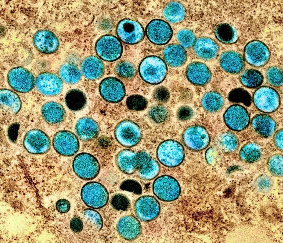 This electron microscope image shows virus particles colored blue inside a cell infected by the monekypox virus.