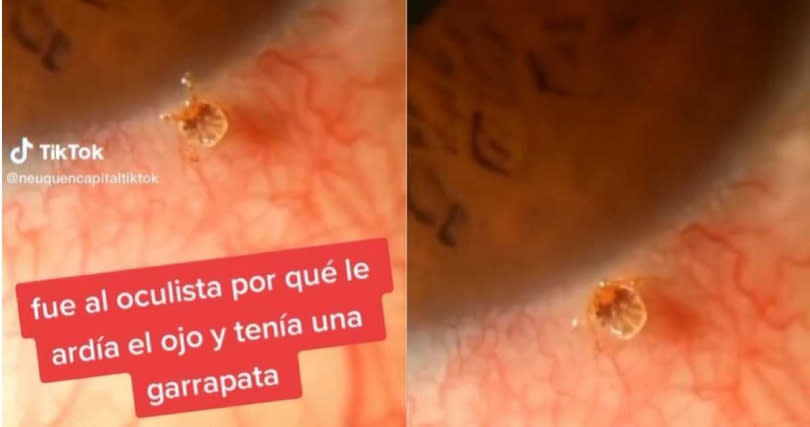 醫師發現，有一隻蜱蟲緊咬著老翁的眼球不放，也造成組織周圍布滿血絲。（圖／翻攝自TikTok／@neuquencapitaltiktok）