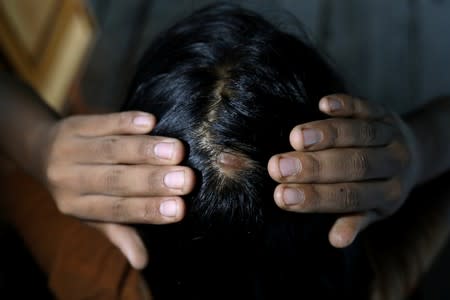 Khin Wutt Yee, 33, shows a scar, which she says were sustained from a broomstick beating by her abusive husband, in the village around Shwelaung, Ayeyarwady