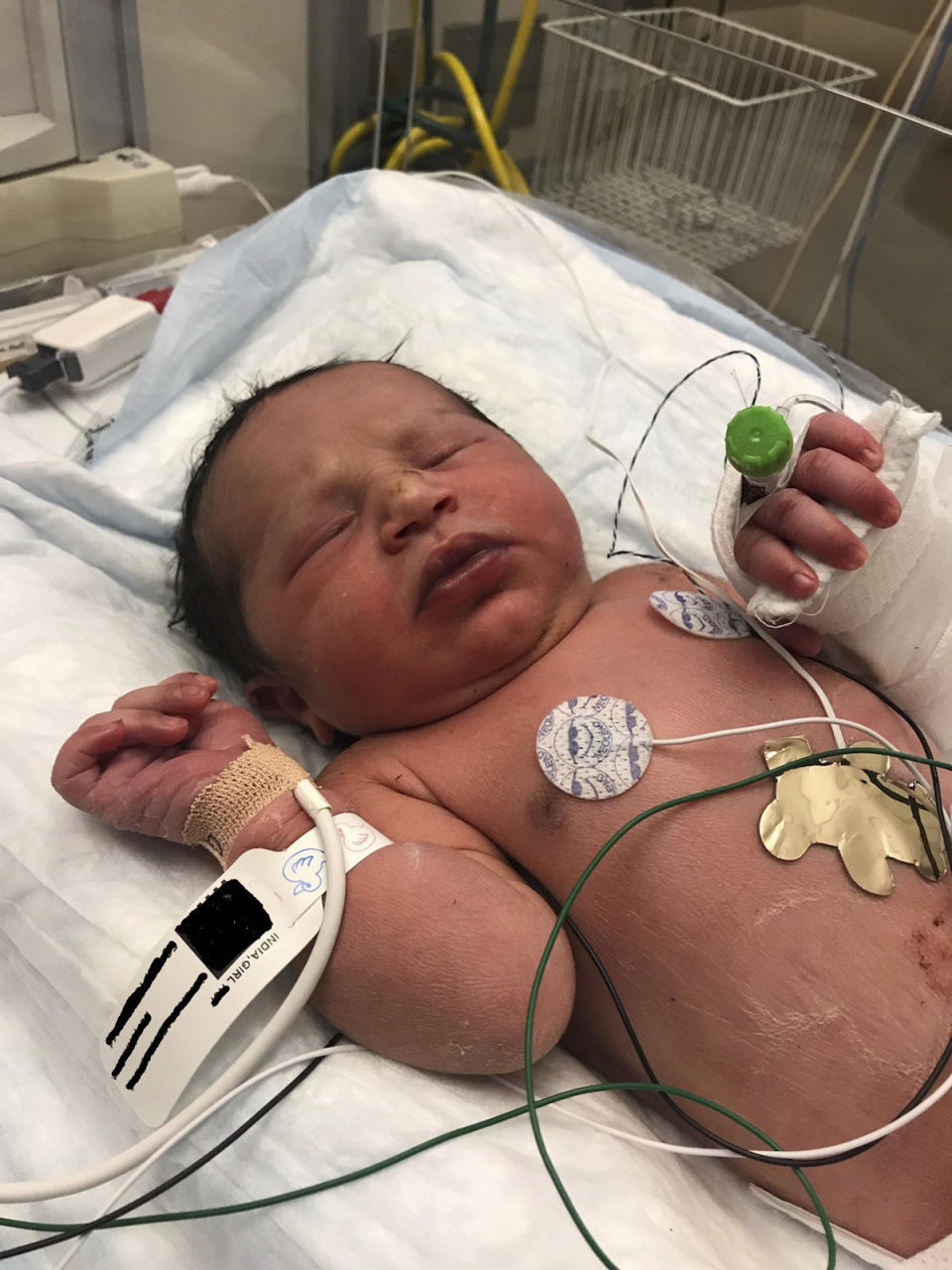 This photo released by the Forsyth County Sheriff's Office shows a newborn baby girl found alive in a plastic bag in a wooded area in Cumming, Ga., by Forsyth County deputies Thursday, June 6, 2019. She was taken to a hospital and is listed in stable condition. (Forsyth County Sheriff's Office via AP)