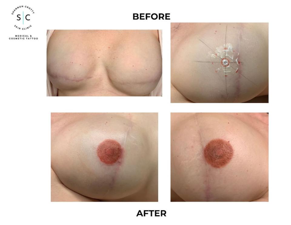 Paramedical tattoo artists, like Crotty, use tattooing techniques to mask scars or recreate features like areolas.