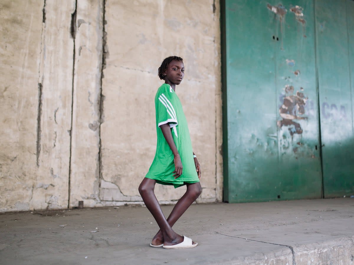 Marie Madeleine, orthopedic patient, before surgery (Shawn Thompson/Mercy Ships/SWNS)