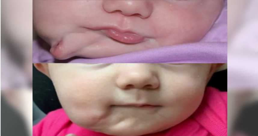 有兩張嘴巴的小嬰兒在動完手術後，恢復正常的外觀。（圖／翻攝自The Sun）