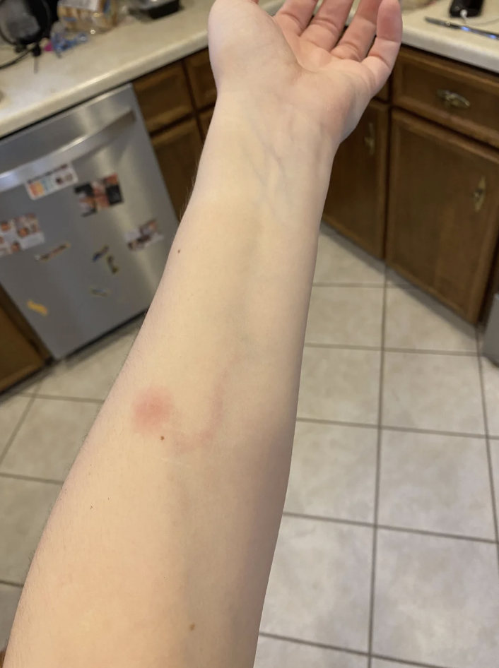 Person's arm with a small bruise, shown against a kitchen background