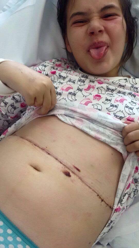 The Argus: Milly's scar from surgery