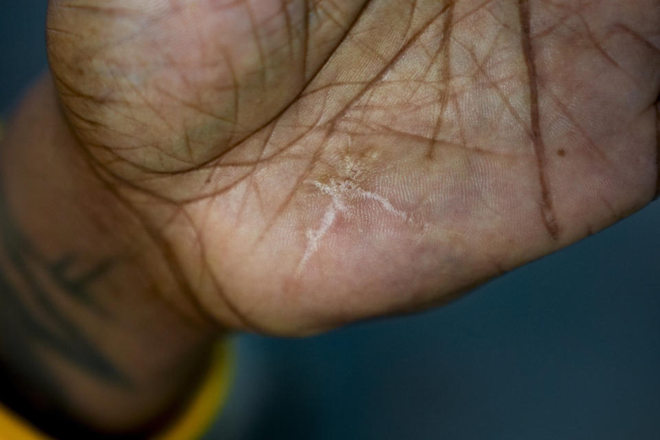 Cloud 9 Cannabis CEO and co-owner Sam Ward Jr. shows a scar on his hand where he was shot during a drug deal gone wrong in 2006, Thursday, Feb. 1, 2024, in Arlington, Wash. Cloud 9 is one of the first dispensaries to open under the Washington Liquor and Cannabis Board's social equity program, established in efforts to remedy some of the disproportionate effects marijuana prohibition had on communities of color. (AP Photo/Lindsey Wasson)